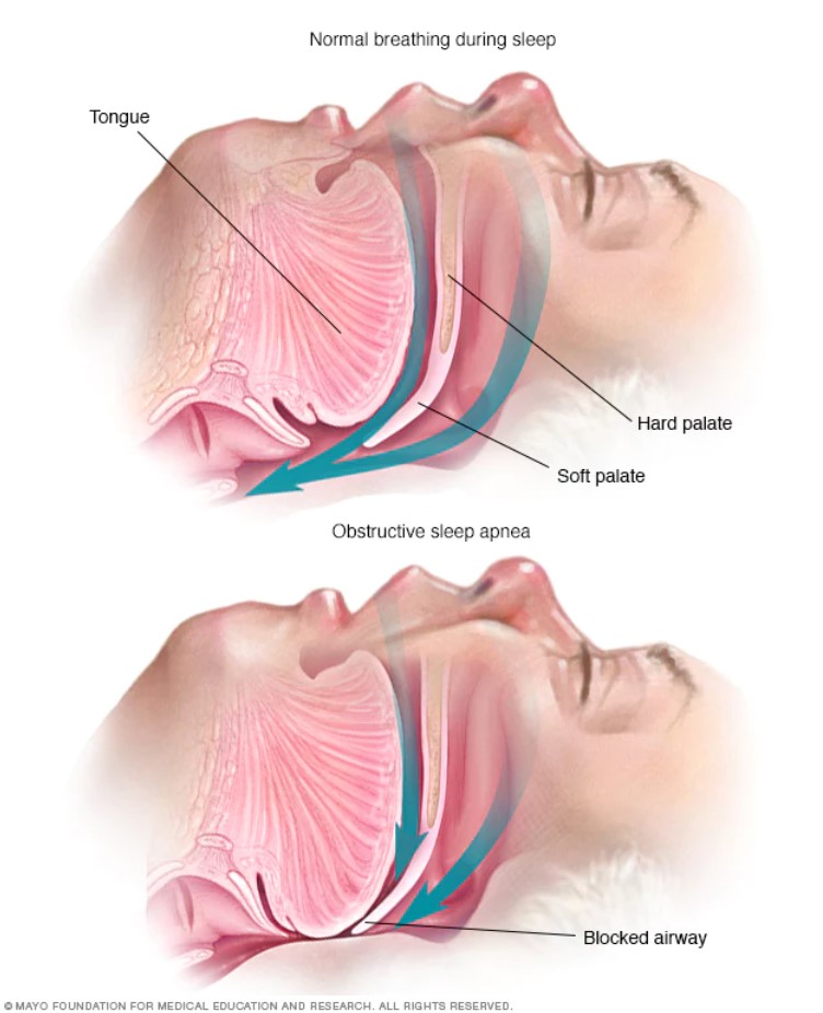 หยุดหายใจขณะหลับจากการอุดกั้น Obstructive Sleep Apnea